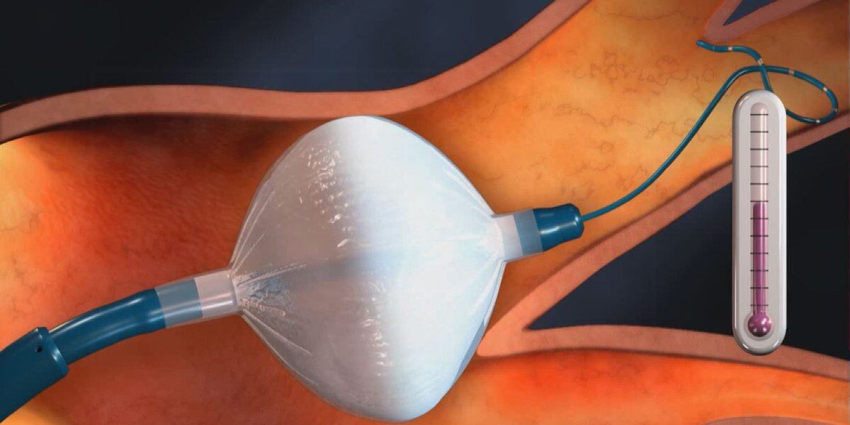 Advantages of Ablation Catheters